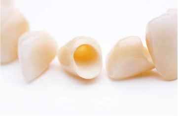 詰め物(インレー)・被せ物(クラウン)